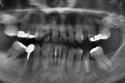 example of a dental x-ray