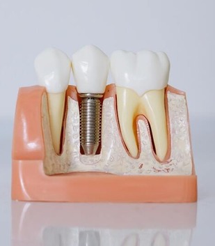 Dental implant fixture