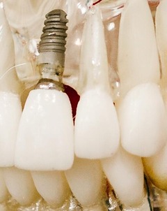 Model of dental implant in a gum