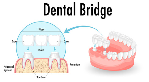 illustration of how a dental bridge works