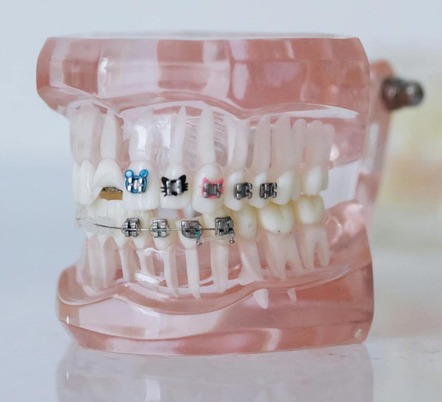 orthodontics on model teeth