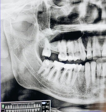 x-ray of a jaw bone