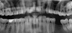 dental x-ray of teeth