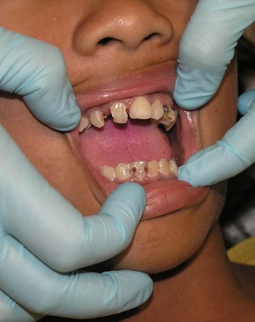 teeth getting prosthodontic treatment