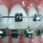 braces pharmacist with teeth whitening products
