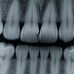 cracked tooth xray illustration of an x-ray of a cracked tooth