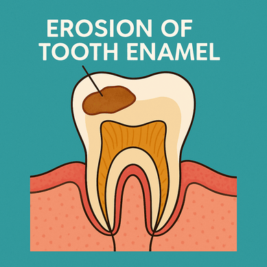 erosion of tooth enamel illustration of tooth enamel erosion