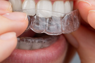 invisalign braces placing invisalign braces on teeth